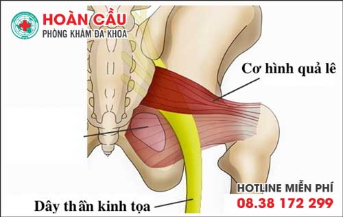 Những điều cần biết về bệnh đau thần kinh tọa